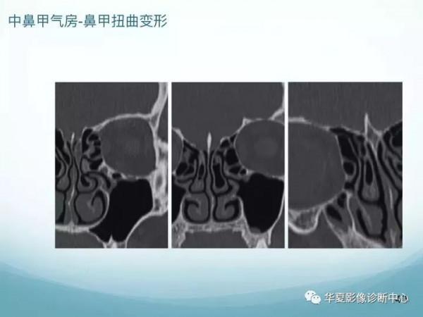 頭頸五官CT斷層解剖圖及常見病影像診斷