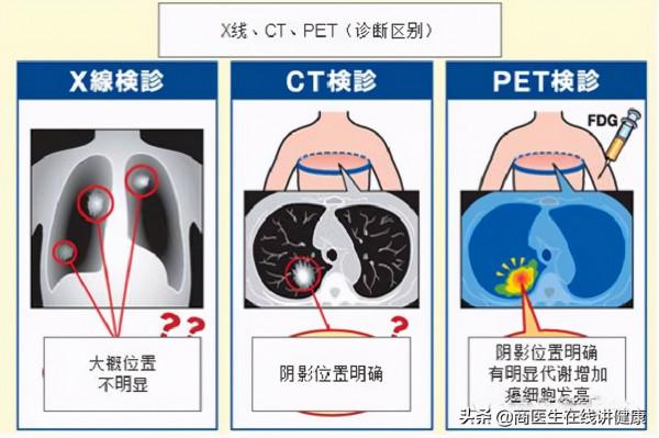 1萬一次的PET-CT是什麼？值得做嗎？