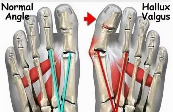 太極拳治含胸駝背頭前伸 太極拳治含胸駝背頭前伸