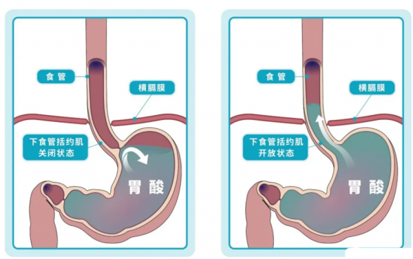 治療胃食管反流病,應該選中醫還是西醫? 治療胃食管反流病,應該選中醫還是西醫?