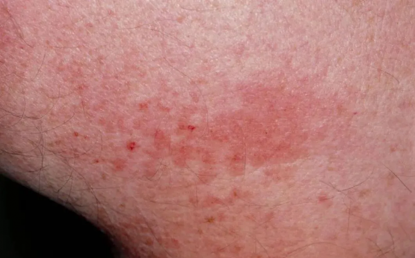 皮疹少了，就是耐藥了嗎？