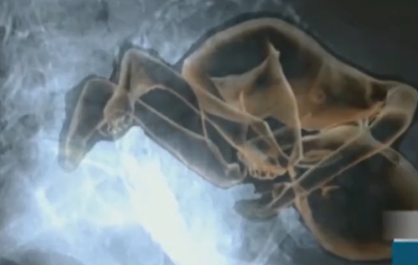 真實故事:91歲老太離奇懷孕,B超檢查胎兒骨骼清晰可見,最後怎樣了