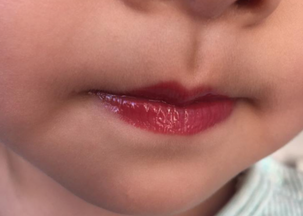 孩子嘴唇裂口又出血，還忍不住撕嘴皮，大夫的處理方式有些意外