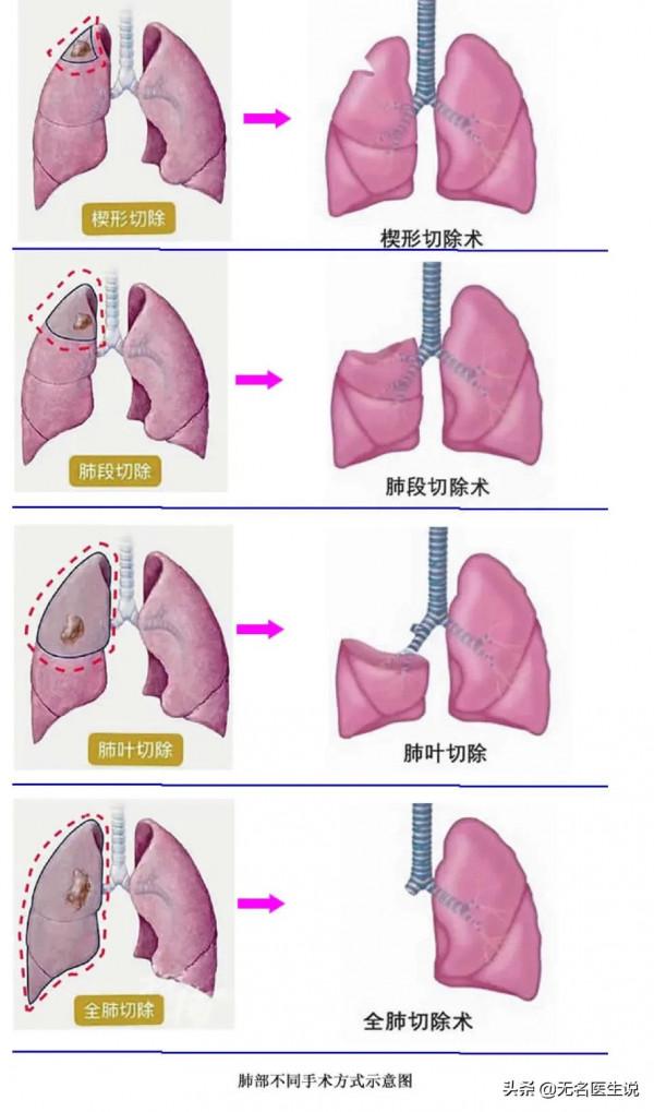 肺結節手術後對生活有哪些影響? 肺結節手術後對生活有哪些影響?
