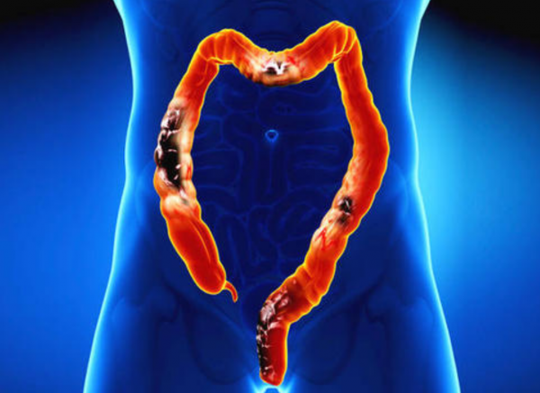 腸道出現問題，或有3個預警症狀，及時檢查，有效保護腸道