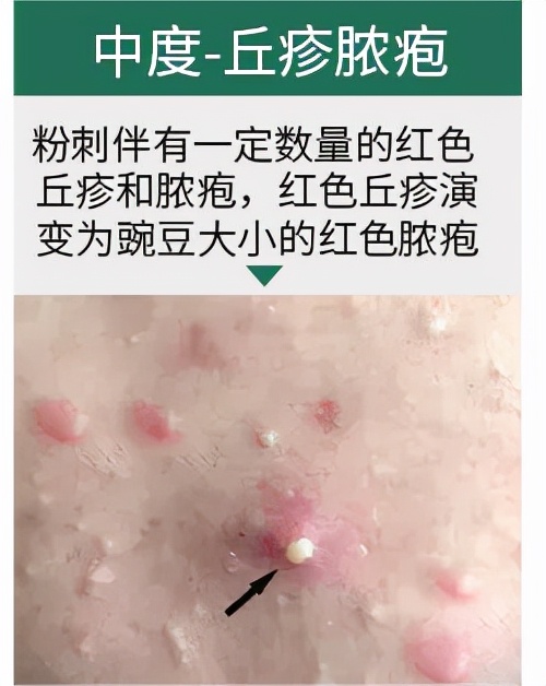 怎麼治療青春痘（痤瘡）？