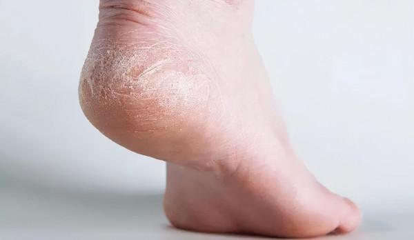 女人老不老,看腳會知道?衰老到來時,腳部可能有這4個變化 女人老不老,看腳會知道?衰老到來時,腳部可能有這4個變化