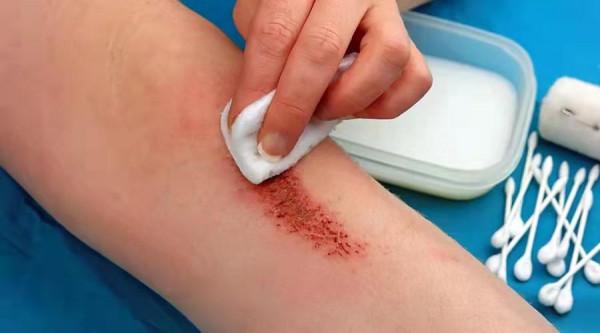 酒精、碘伏、碘酒，還是雙氧水…哪種處理傷口最好？