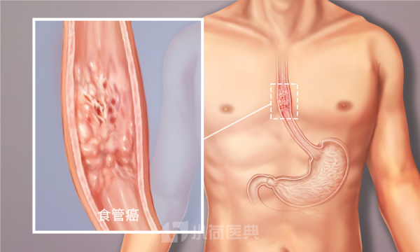 食道癌三處疼痛位置圖 食道癌三處疼痛位置圖