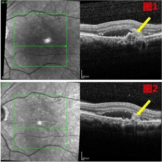 新進展！基因診斷與治療，為難治性年齡相關黃斑變性患者，提供新選擇