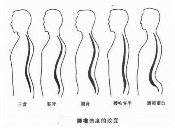 下交叉綜合徵是怎麼回事? 下交叉綜合徵是怎麼回事?