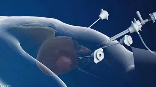 “膽結石”知多少！你真的有了解過“膽結石”嗎？