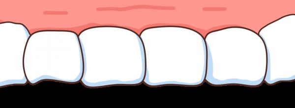 天天刷牙為啥還長蛀牙?也許你忽視了這些事兒…… 天天刷牙為啥還長蛀牙?也許你忽視了這些事兒……