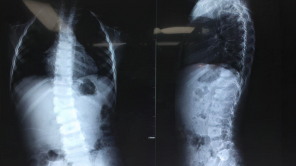 孩子高低肩、身子歪或許是半椎體畸形惹的禍，不要不當回事