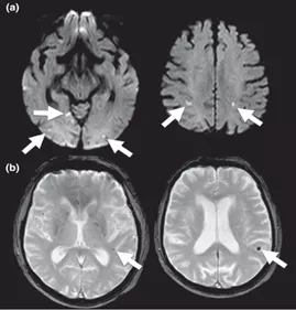磁共振上出現腦微出血,這11種病因要考慮 磁共振上出現腦微出血,這11種病因要考慮