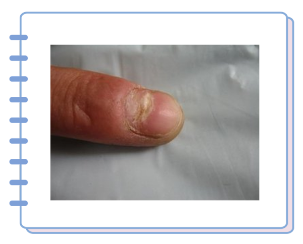 得了灰指甲,反覆發作難根治?一次性介紹7種藥,總有一款適合你 得了灰指甲,反覆發作難根治?一次性介紹7種藥,總有一款適合你