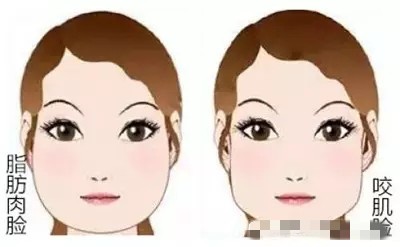 面部吸脂你真的都瞭解嗎？來看看面部吸脂的常見問題解答