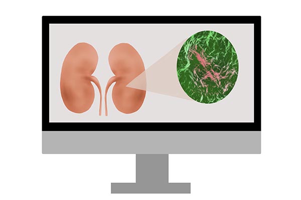 腎病進入終末期，只能透析和換腎？哪種療法更好？醫生為您講清