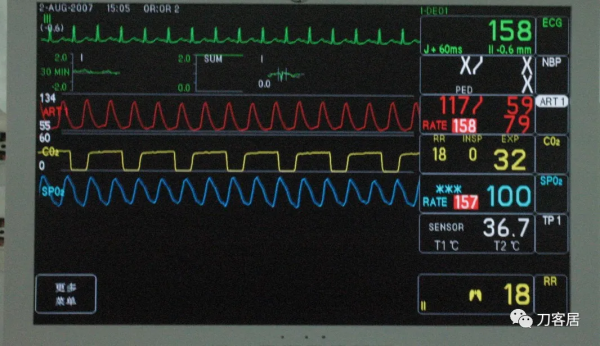 惡性高熱第1例:2007年西京醫院術中“惡性高熱”一例 惡性高熱第1例:2007年西京醫院術中“惡性高熱”一例