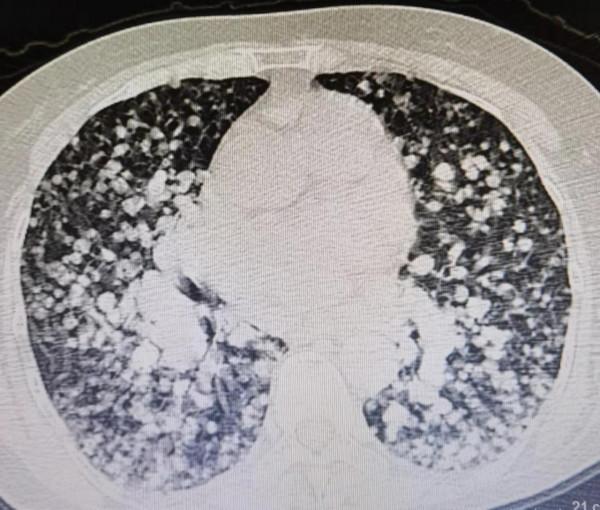 天啊！這個肺千瘡百孔，到底怎麼了？原來是肺轉移癌