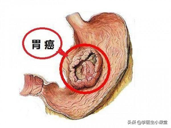 胃痛大半年,患者做胃鏡查出潰瘍,醫生:你這個情況是胃癌 胃痛大半年,患者做胃鏡查出潰瘍,醫生:你這個情況是胃癌
