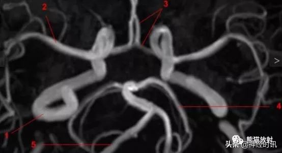 Willis環丨超細解剖+超全變異