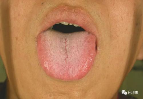 看中醫時大夫讓你“伸舌頭”,到底是在看什麼? 看中醫時大夫讓你“伸舌頭”,到底是在看什麼?