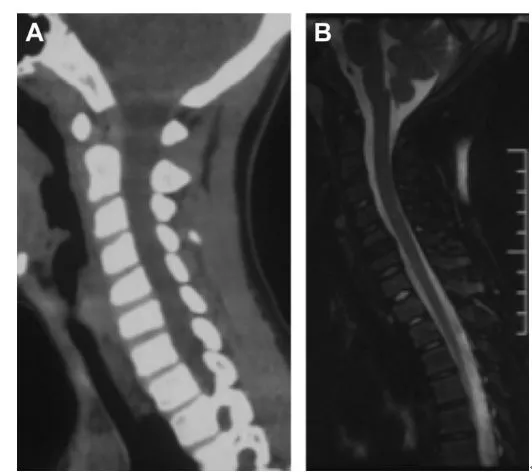 頸椎少見的3種鈣化性疾病 頸椎少見的3種鈣化性疾病