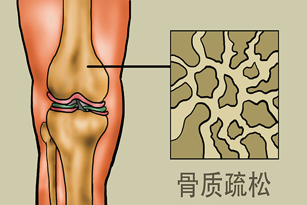 只有老年人才會得骨質疏鬆?錯了!3類人也要定期檢查骨密度 只有老年人才會得骨質疏鬆?錯了!3類人也要定期檢查骨密度