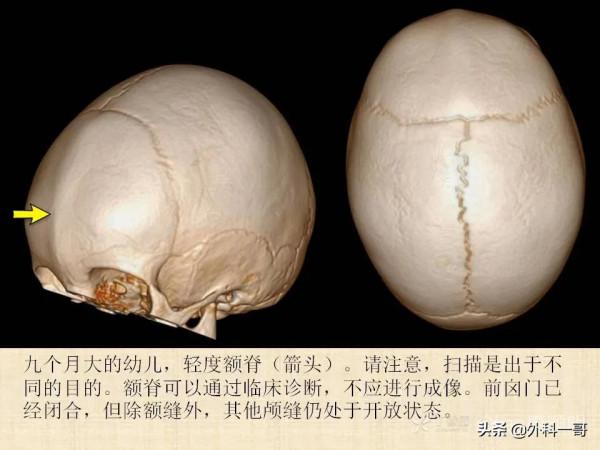 小兒顱縫早閉的診斷治療