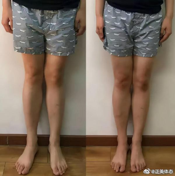 最全腿型解析都在這,腿不直的人對號入座 最全腿型解析都在這,腿不直的人對號入座