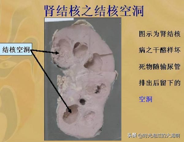 關於“肺結核”的幾點認識
