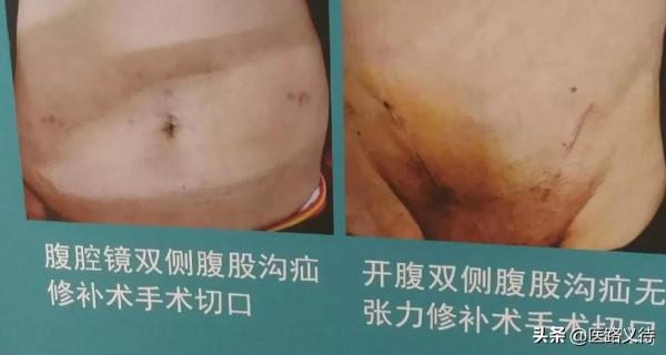 兒童腹股溝疝 兒童腹股溝疝