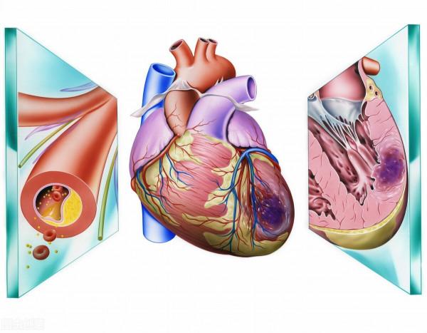50歲急性心梗，植入支架也沒能救命！醫生嘆息：這些併發症更要命