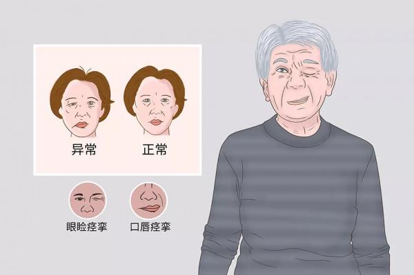 “擠眉弄眼”警惕梅傑綜合徵 “擠眉弄眼”警惕梅傑綜合徵