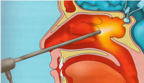 44歲加拿大華人萬里求醫，神外專家妙手除疾