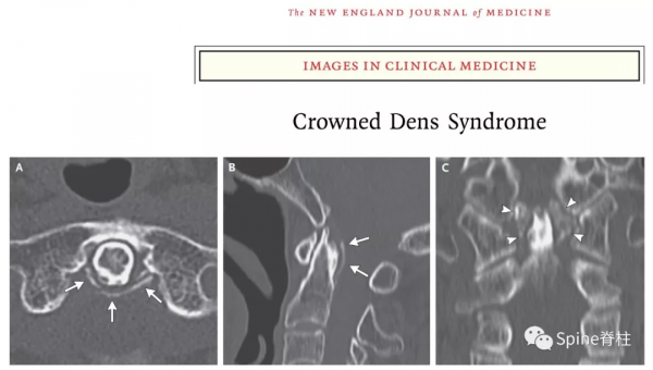 頸椎少見的3種鈣化性疾病 頸椎少見的3種鈣化性疾病