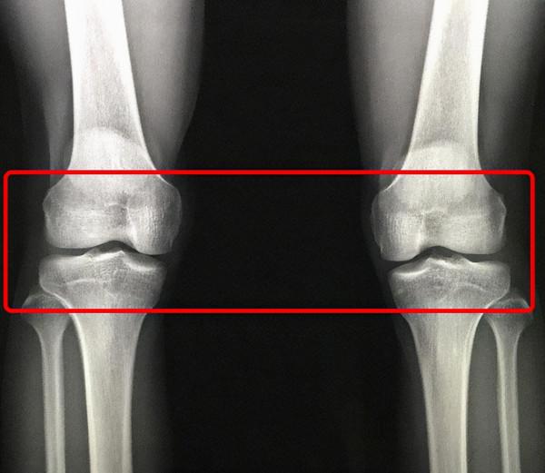20歲小夥淨身高才169？骨骺線閉合後，還能再長高嗎？