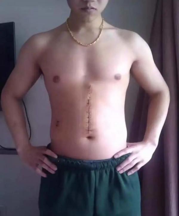 健身榜樣|胃癌帶給他20cm傷疤靠健美重塑鋼鐵之軀,鐵血戰士王寅 健身榜樣|胃癌帶給他20cm傷疤靠健美重塑鋼鐵之軀,鐵血戰士王寅