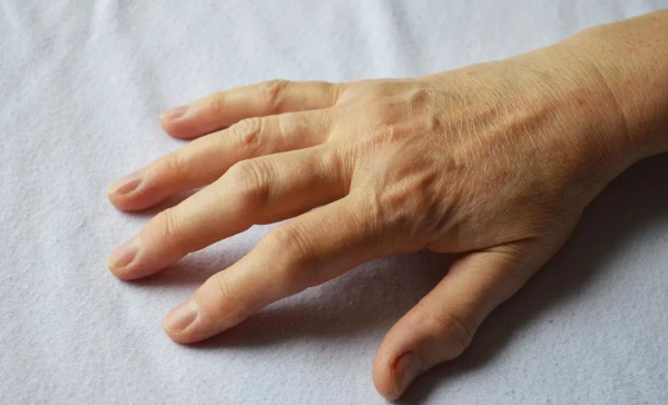 不想類風溼來“拜年”，日常防護不可少