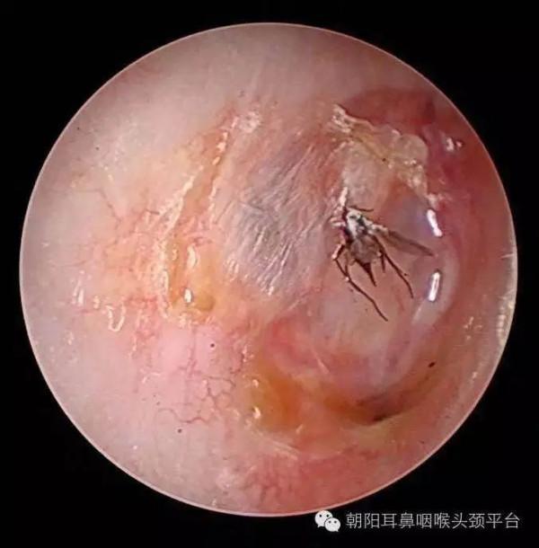 耳朵進了東西怎麼辦？