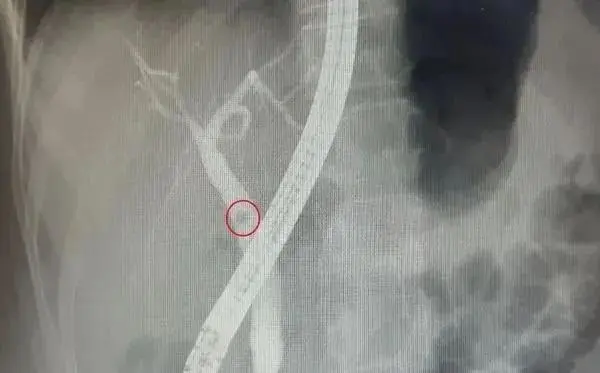 一泡尿揪出病灶