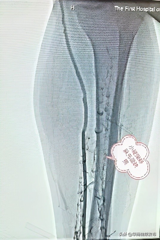 一次跑步差點兒要了28歲小夥的命...