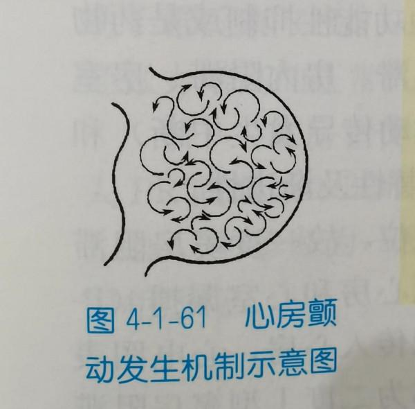 房顫的心電圖分析訣竅和房顫的科普解釋,專業和通俗的完美結合 房顫的心電圖分析訣竅和房顫的科普解釋,專業和通俗的完美結合