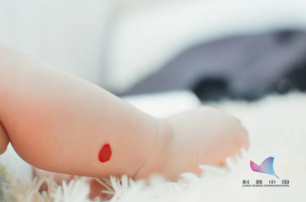 “胎記”也分好壞？長這樣的可能惡變，一定要注意