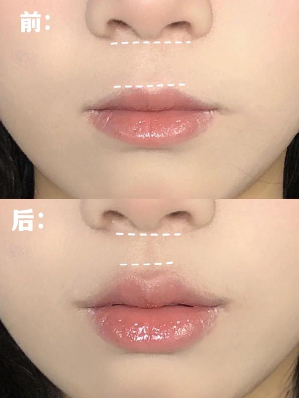 乾貨，改善凸嘴&sol;長人中，人中縮短大法