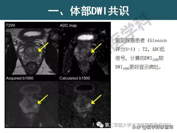 體部DWI共識及胰腺DWI研究經驗介紹