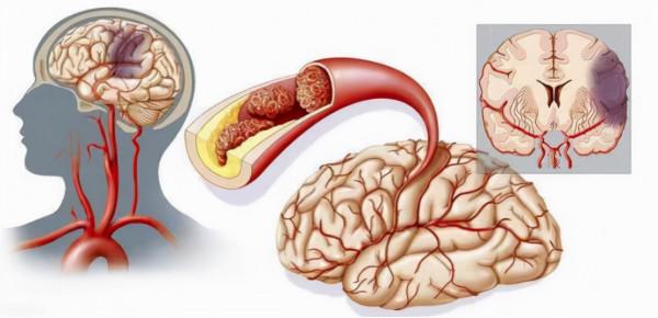 得了腔隙性腦梗塞，會不會偏癱，要不要把血管疏通一下？