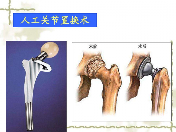 老人股骨頸骨折，關節置換，還是螺釘固定？看看醫生怎說