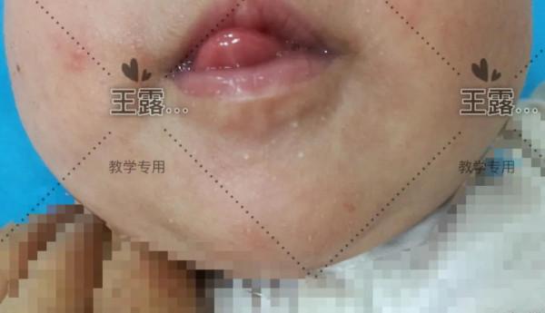 新生兒一過性面板病（上）